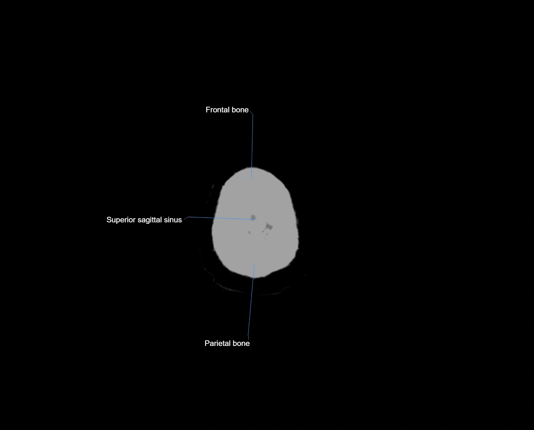 CT scan brain axial labelled cross sectional anatomy image-img-000072.webp